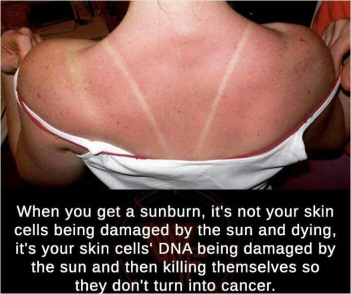 Sunburnt back of a person showing tan lines, illustrating DNA damage, related to how everything works.