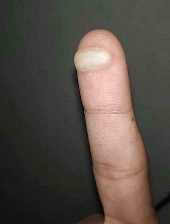 I Burnt My Finger For The Second Time, Now What?