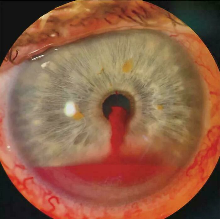 Close-up of an eye with a unique medical condition, showcasing remarkable aspects of the human body.