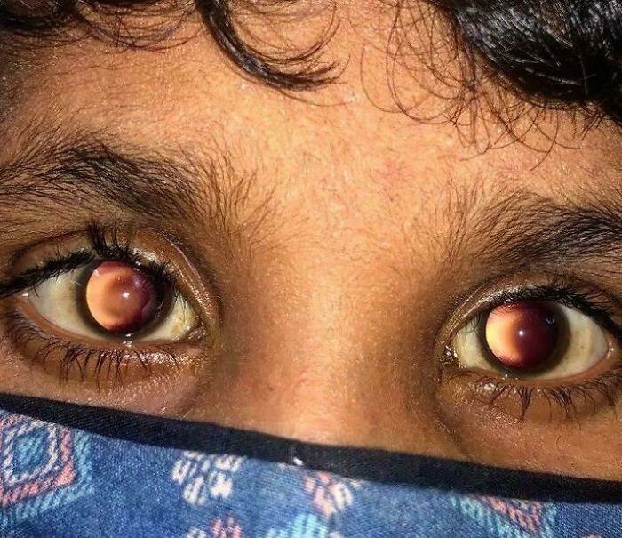 Close-up of eyes showcasing an unusual medical condition, highlighting the human body's complexity.