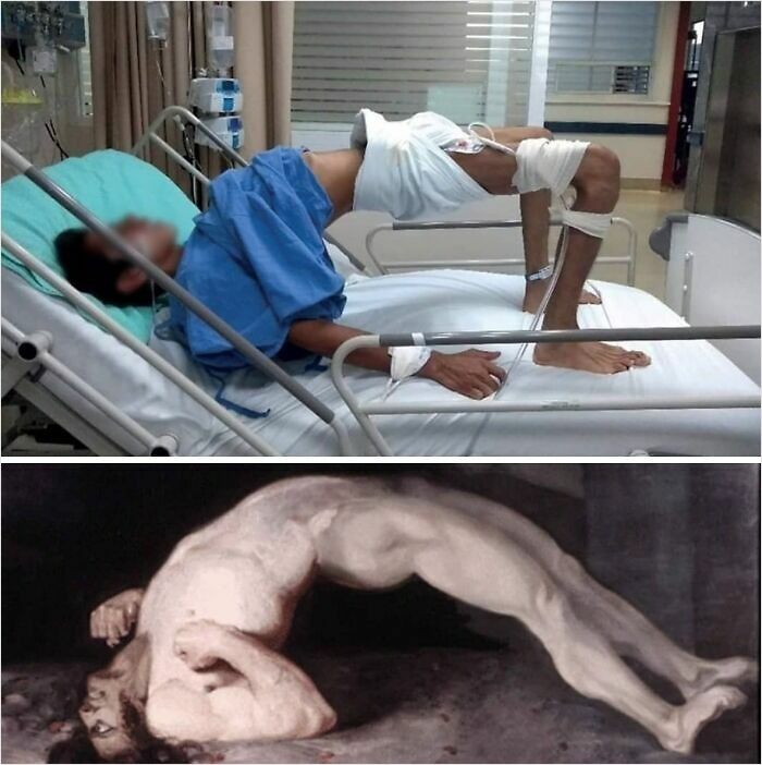 Patient in hospital bed mimicking artistic pose illustrates intriguing medical case, highlighting human body capabilities.