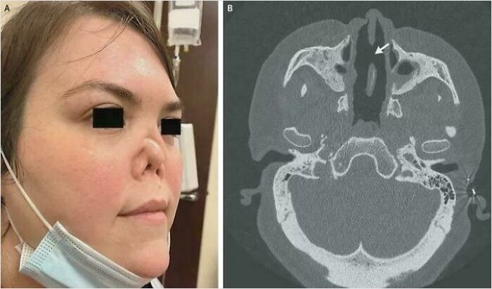 Patient's face with a nasal implant, alongside a medical CT scan, illustrating an interesting medical case.