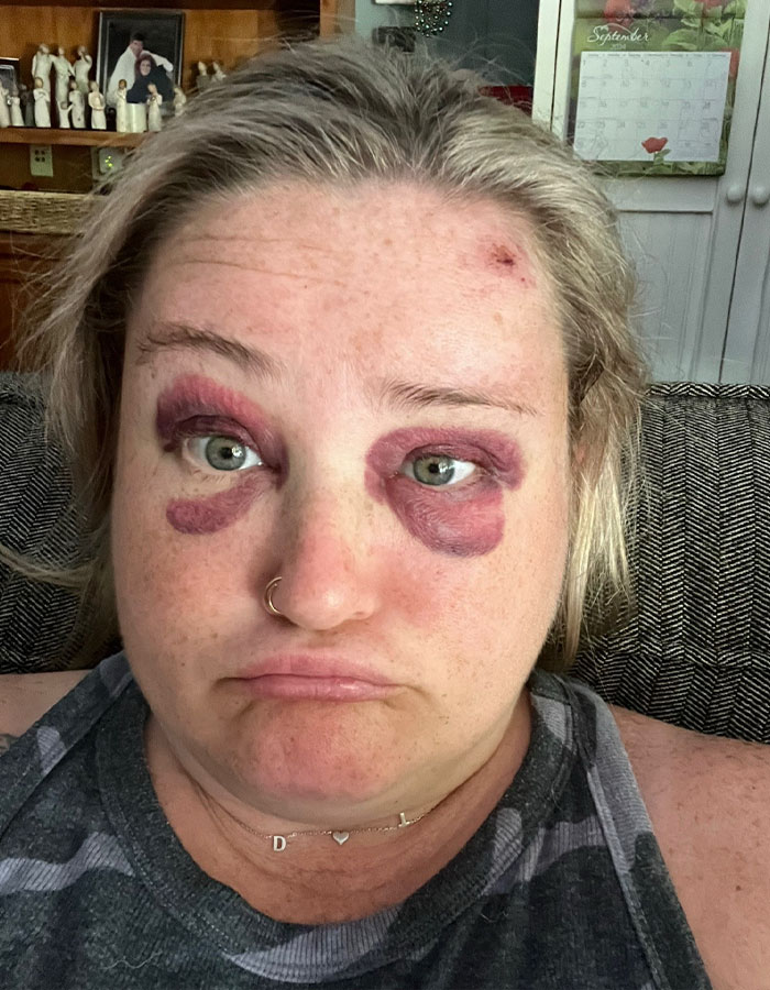 "That Artist Is A Wizard!": Bride With Facial Bruises Reveals Stunning Makeup Transformation