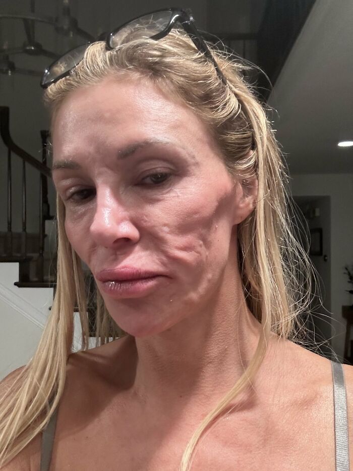 Swollen-Faced Brandi Glanville Says She Can Feel The “Parasite” Having “Babies In [Her] Face”