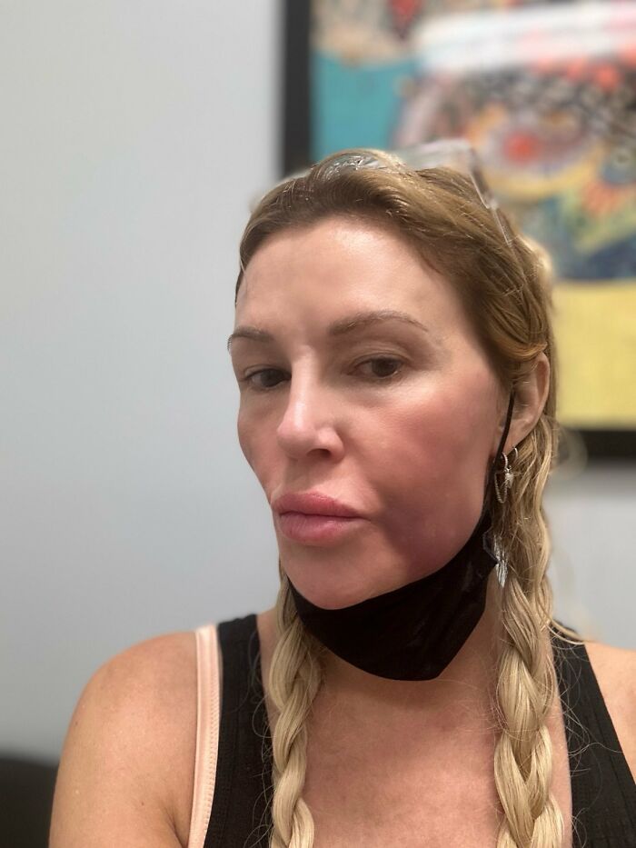 Swollen-Faced Brandi Glanville Says She Can Feel The “Parasite” Having “Babies In [Her] Face”