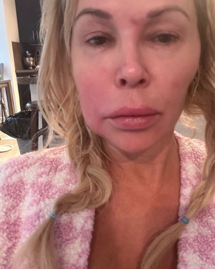 Swollen-Faced Brandi Glanville Says She Can Feel The “Parasite” Having “Babies In [Her] Face”