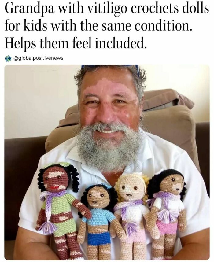 Smiling man with vitiligo holding crocheted dolls, showcasing wholesome kindness by supporting kids with similar conditions.