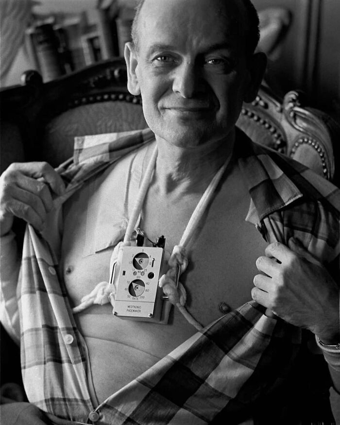 Man with early pacemaker on his chest, showcasing historical medical advancement.