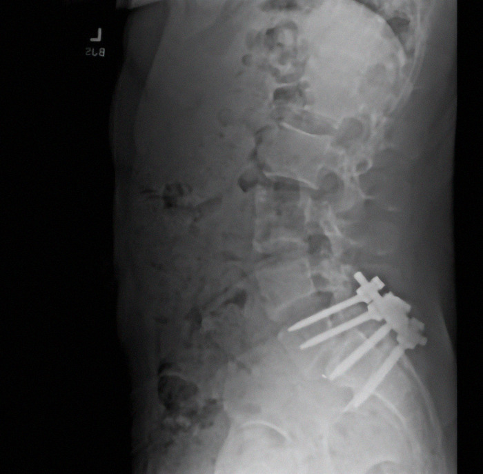 X-ray of Luigi Mangione's spine with screws, highlighting a medical procedure.