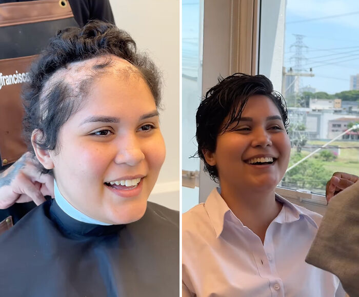 Brazilian barber provides hair prosthetics to kids, showing before and after transformation with a smiling young girl.