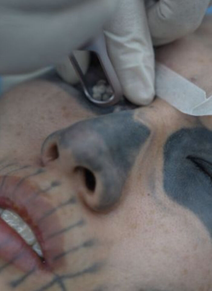 Man Forced To Get Rid Of Facial Tattoo After Struggling To Find Jobs: "I Face Constant Insults"