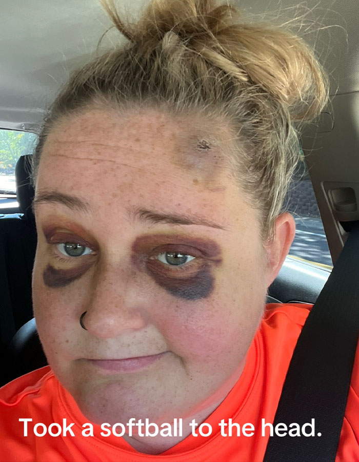 "That Artist Is A Wizard!": Bride With Facial Bruises Reveals Stunning Makeup Transformation