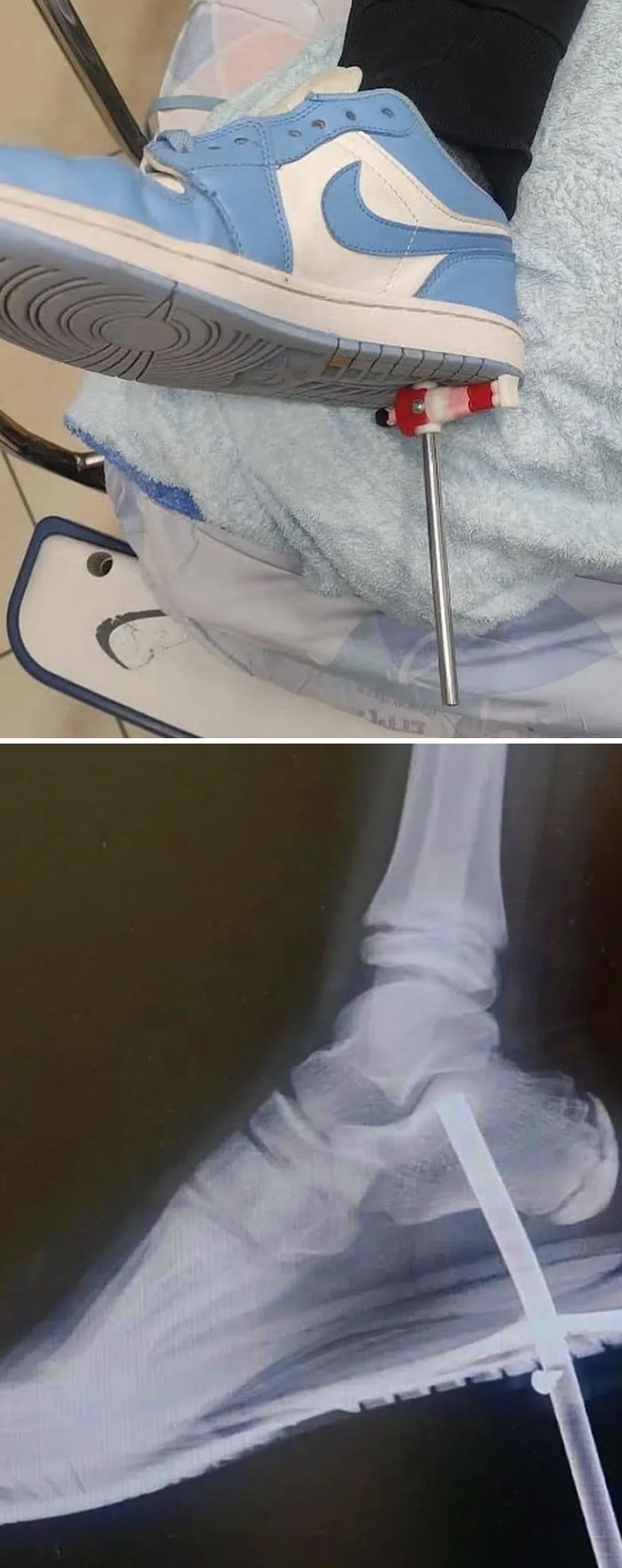 Foot with external fixator and shoe, X-ray reveals metal rod through the foot highlighting an interesting medical case.