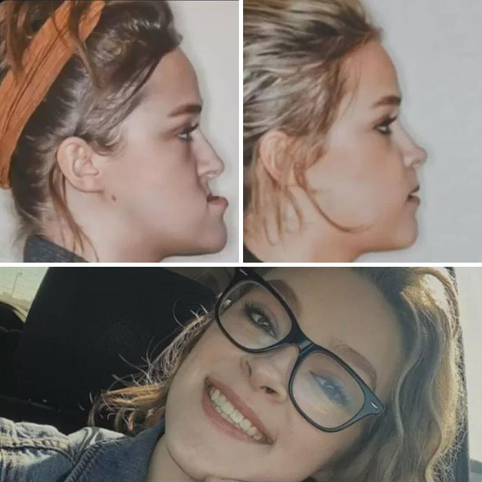 Before and after medical case showing jaw transformation with a smiling woman wearing glasses and a headband.