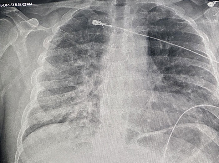 X-ray showing unexpected Christmas accident with a decoration lodged in the chest area.