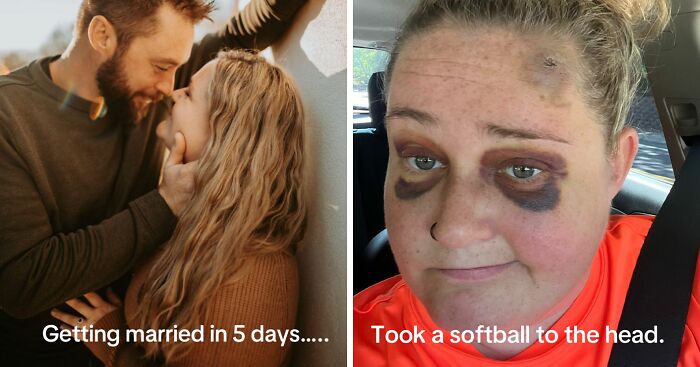 “That Artist Is A Wizard!”: Bride With Facial Bruises Reveals Stunning Makeup Transformation