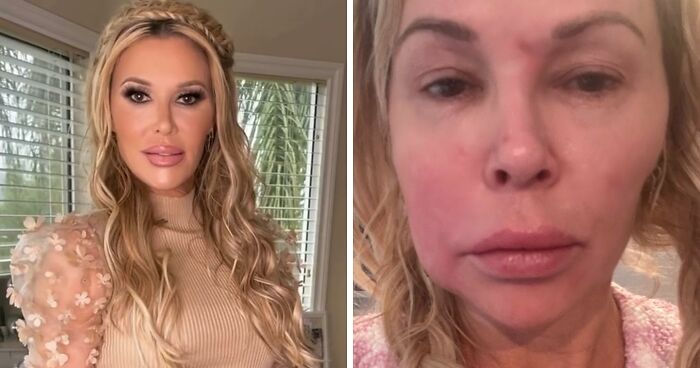 Swollen-Faced Brandi Glanville Says She Can Feel The “Parasite” Having “Babies In [Her] Face”