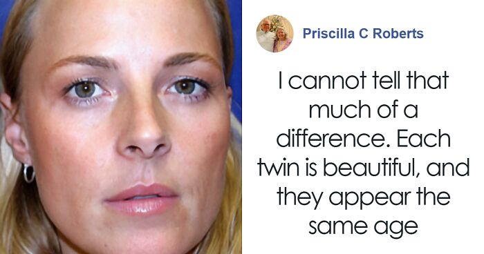 Twin Sisters Prove Botox’s Effectiveness In “Groundbreaking” Study: 