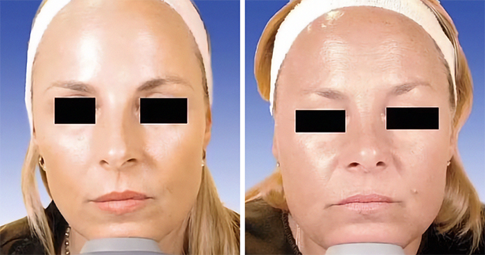 Twin Study Of Botox vs. Natural Aging Sparks Debate: “Beauty Is Defined By So Much More”