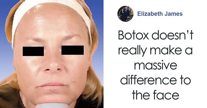 Scientist Challenges Aging, Explaining Botox Study On Identical Twins: 