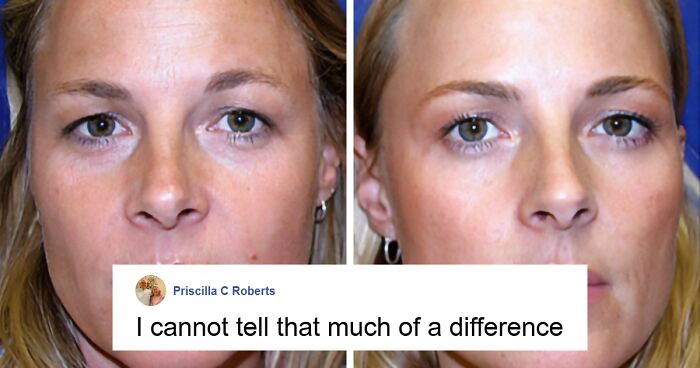 Netizens Cast Doubt On Botox Study As Photos Of Twins Comparing It To Natural Aging Go Viral