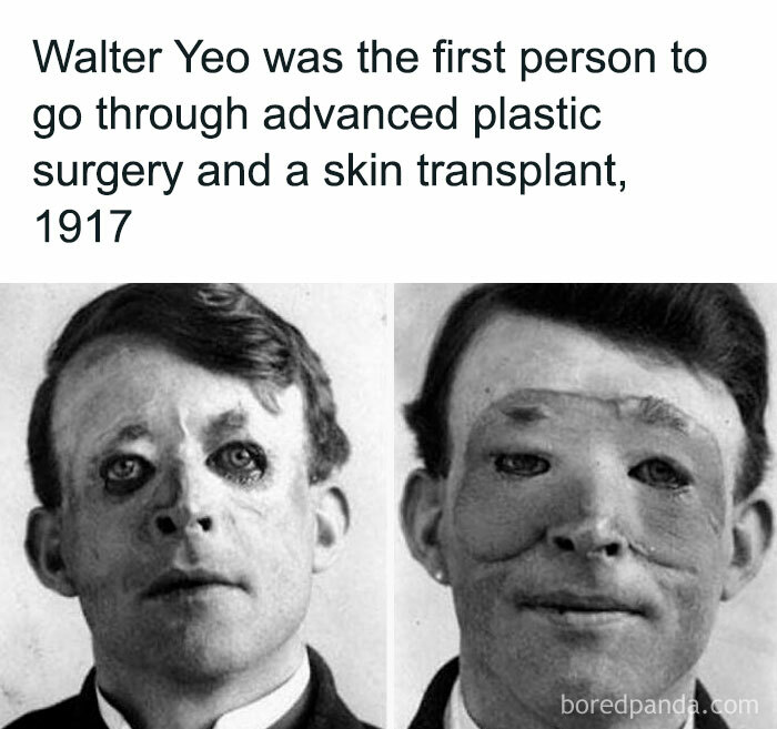 "Historical photo of Walter Yeo, first advanced plastic surgery and skin transplant recipient, 1917."