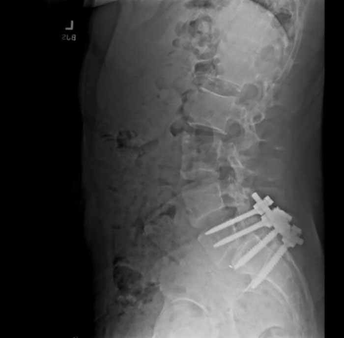 X-ray image showing spinal screws, highlighting injury impact on intimacy.