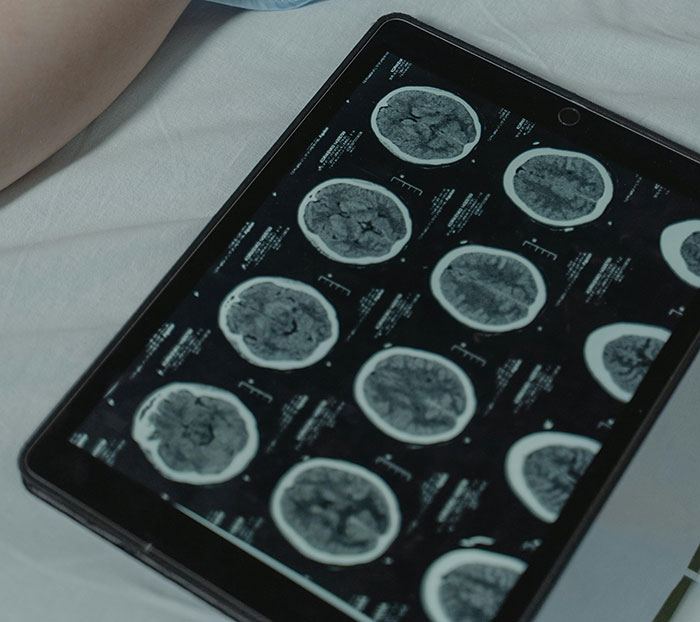 Tablet displaying brain scans showcasing unique rare statistics.