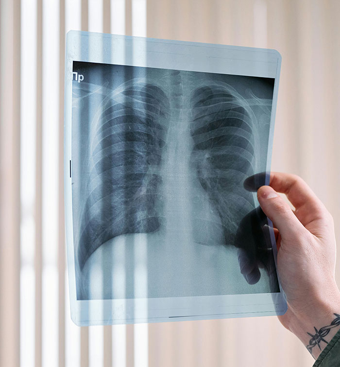 X-ray image held by a person, showcasing unique lung structure.