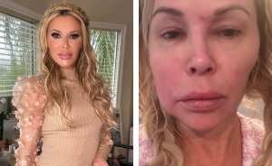 Swollen-Faced Brandi Glanville Says She Can Feel The “Parasite” Having “Babies In [Her] Face”