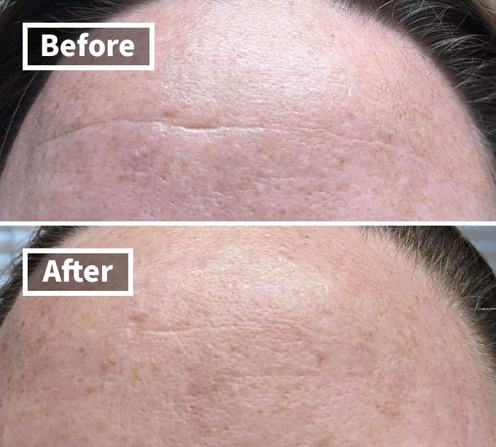 Before and after images of forehead showing treatment results for unavoidable body issues.