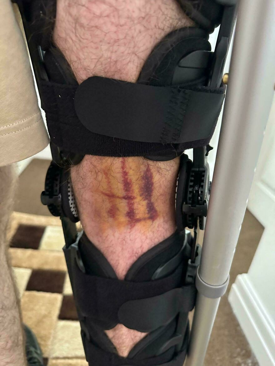 A knee brace with a bruise that resembles a tree on the leg of a person.