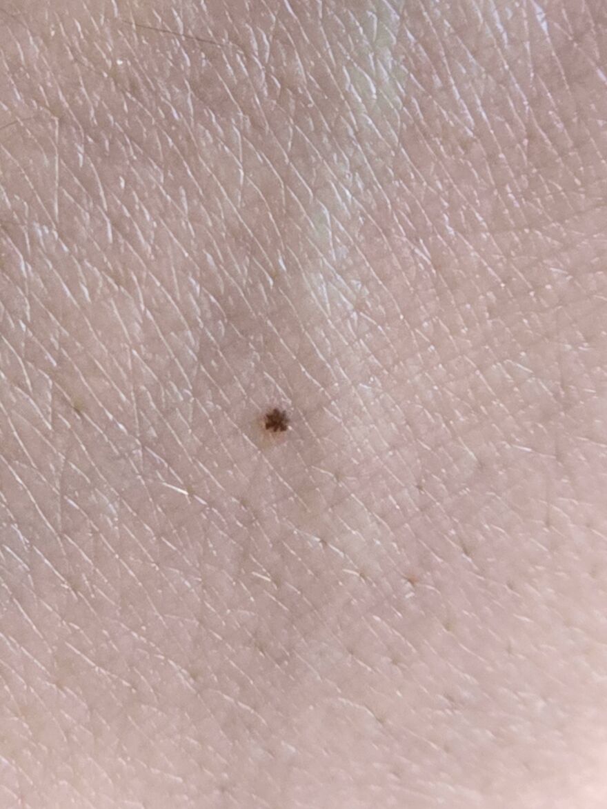 Small mole on skin resembling a tiny star, showcasing how things look like other things.