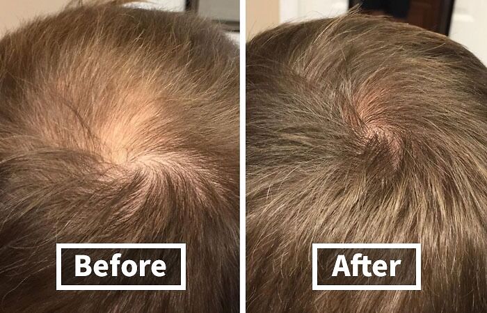 Before and after hair regrowth comparison showing the effect of products available in Amazon winter deals discounts.