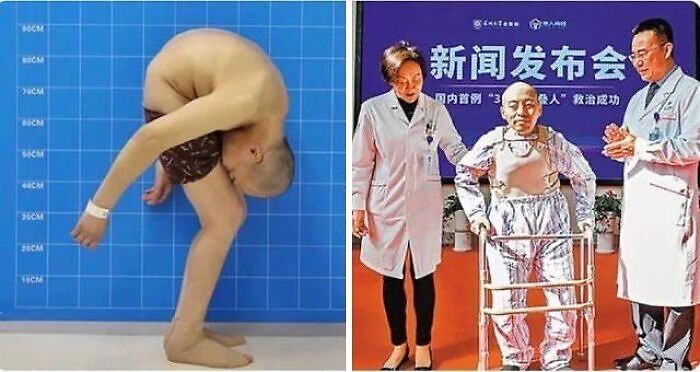 Chinese Man, Li Hua, More Commonly Know As The “Folded Man”, Finally Stands Up Straight After 28 Years Of Suffering From Ankylosing Spondylitis. All Thanks To A Life-Changing Surgery