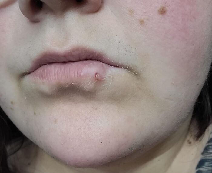 Close-up of a person's lips with a cold sore, highlighting unavoidable body issues.