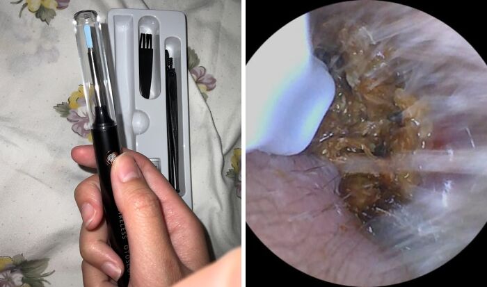 Hand holding an ear cleaning tool with a close-up image of earwax, highlighting body issues.