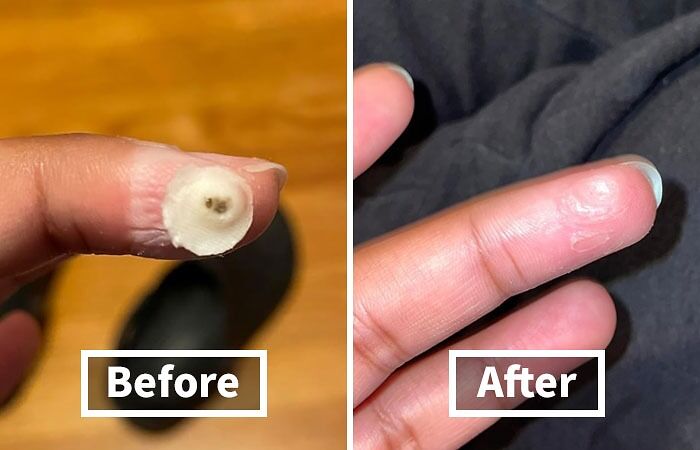 Before and after images showing skin improvement on a finger, highlighting unavoidable body issues.