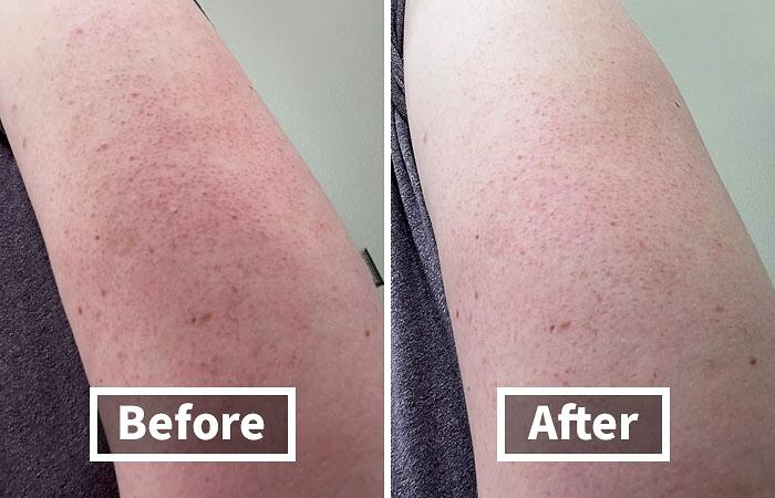 Before and after image showing skin improvement, addressing unavoidable body issues on the arm.