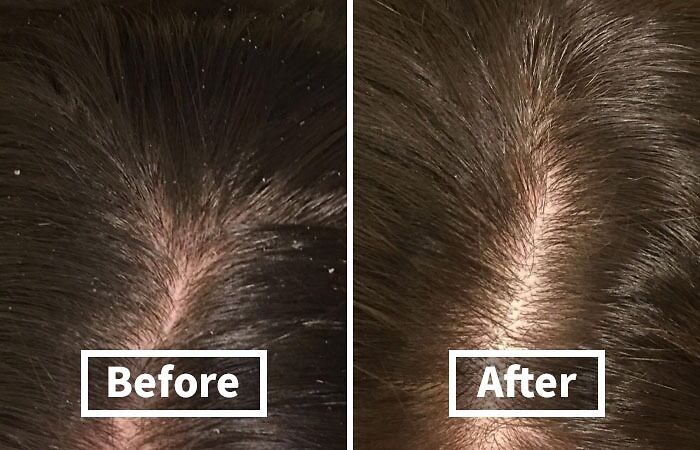 Before and after comparison showing hair scalp with dandruff, addressing unavoidable body issues.