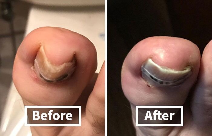 Before and after images of toenail improvement showcasing unavoidable body issues.