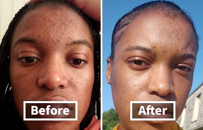 Before and after images showing improvements in skin texture related to unavoidable body issues.