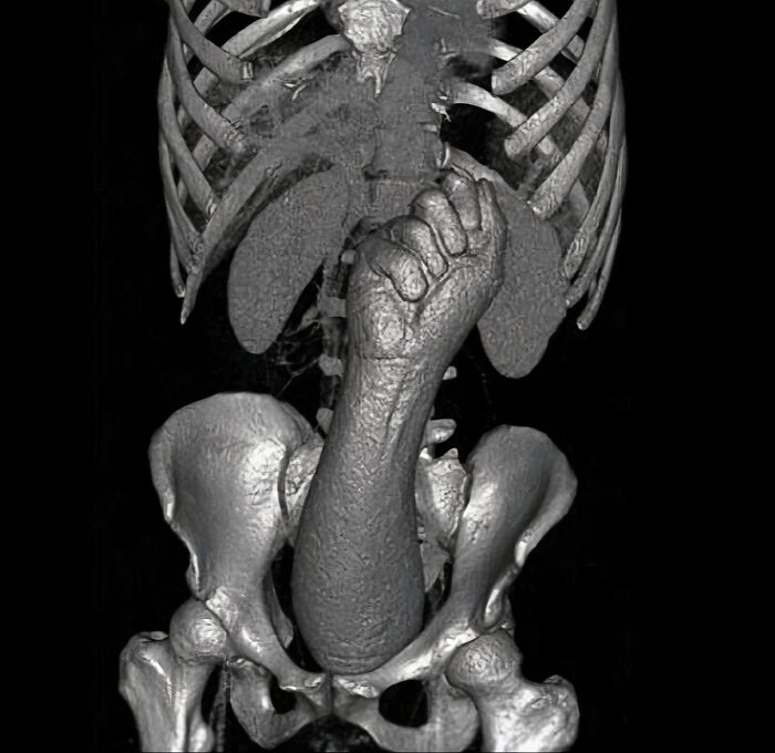 X-ray showing a skeleton with an unusual internal object resembling a fist, highlighting unexpected medical imagery.