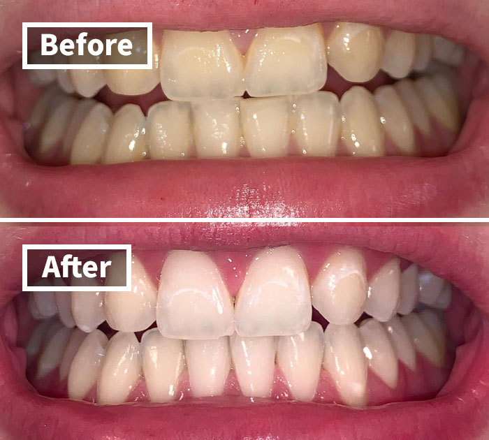 Before and after teeth whitening using personal care products.