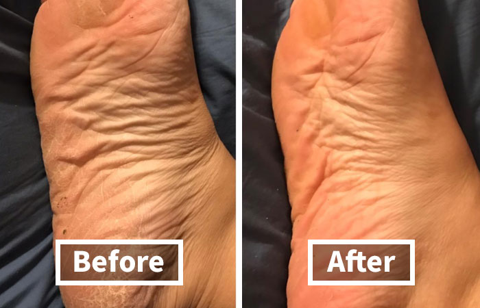 Before and after images of improved foot skin texture addressing unavoidable body issues.