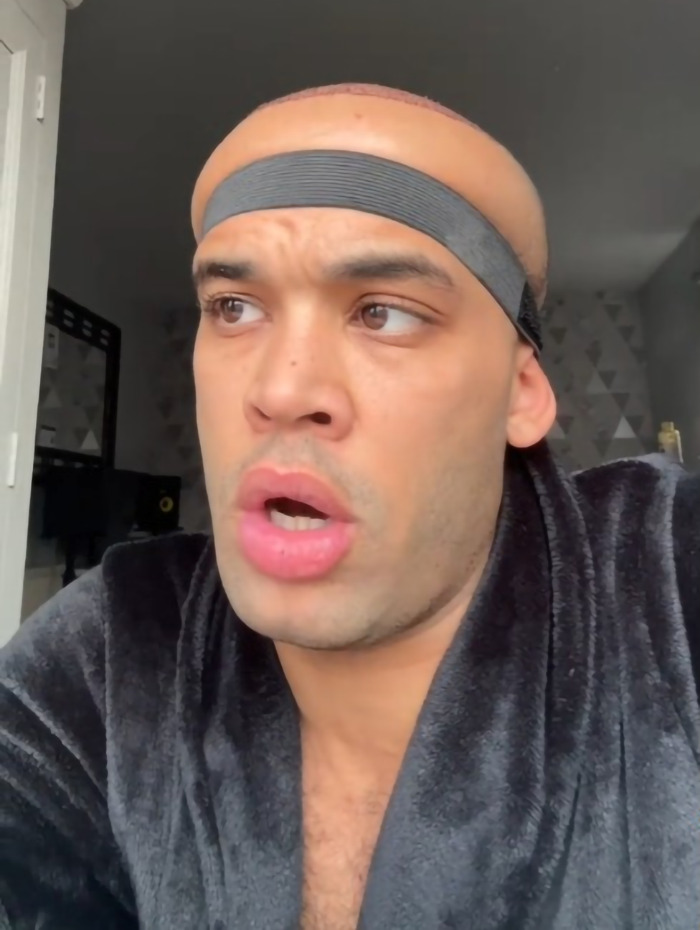 Kanah Flex shows hair transplant results with headband, looking surprised.