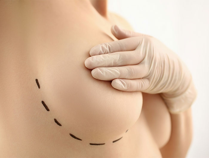 Person with marked chest for breast reduction consultation, wearing gloves.