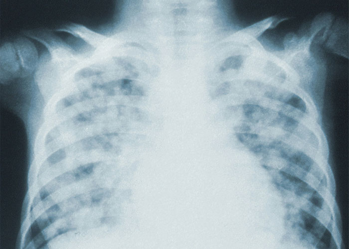 X-ray image of a human chest highlighting unsettling medical facts.