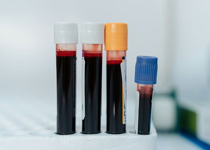 Blood samples in test tubes, illustrating unsettling medical facts in a clinical setting.