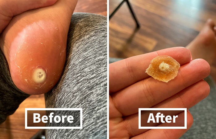 Before and after using personal-care-products on foot callus, illustrating skin improvement.